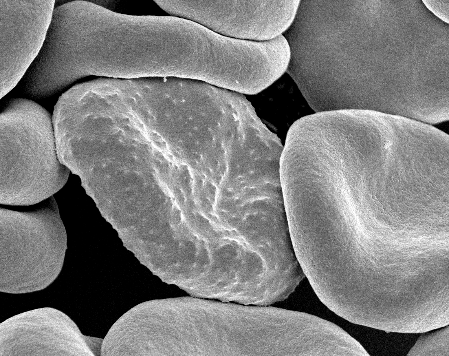 Imagem de referência de malária, descrito nos dados abertos como doença infecciosa transmitida por mosquitos e causada por protozoários parasitários do género Plasmodium