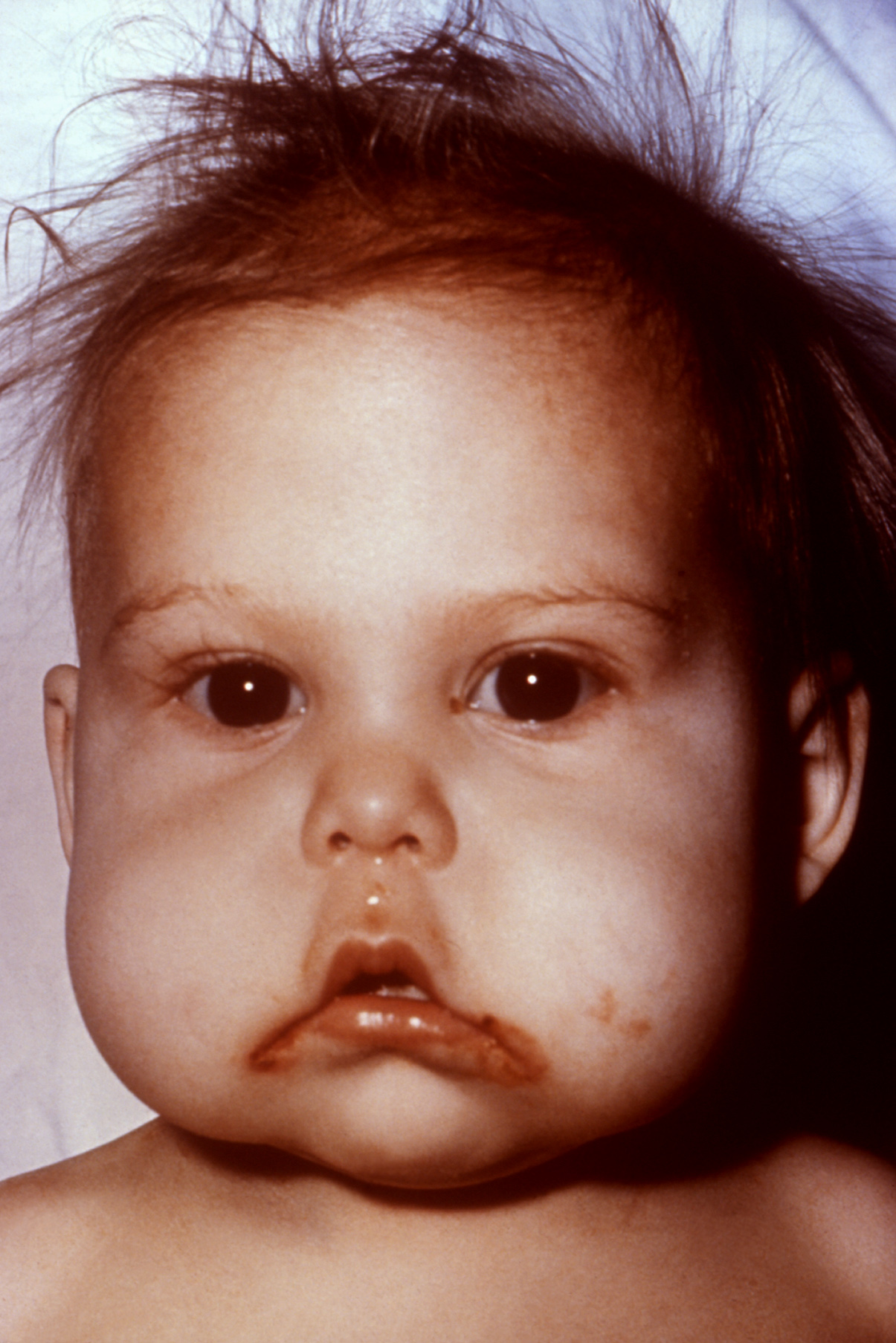Imagem de referência de desnutrição, descrito nos dados abertos como condição em que se verificam problemas de saúde como resultado de uma dieta com consumo insuficiente ou excessivo de nutrientes, comprometendo funções fisiológicas essenciais