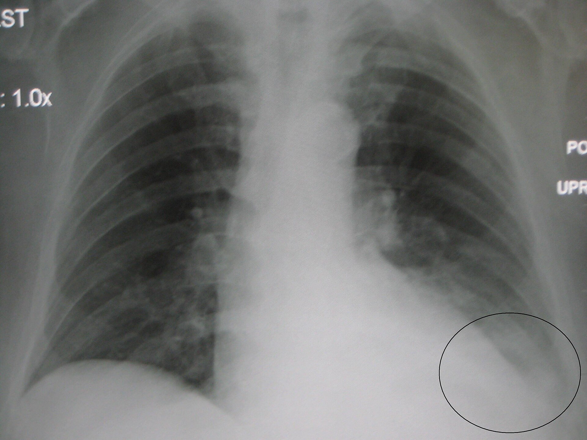 Imagem de referência de pneumonia, descrito nos dados abertos como inflamação dos alvéolos pulmonares