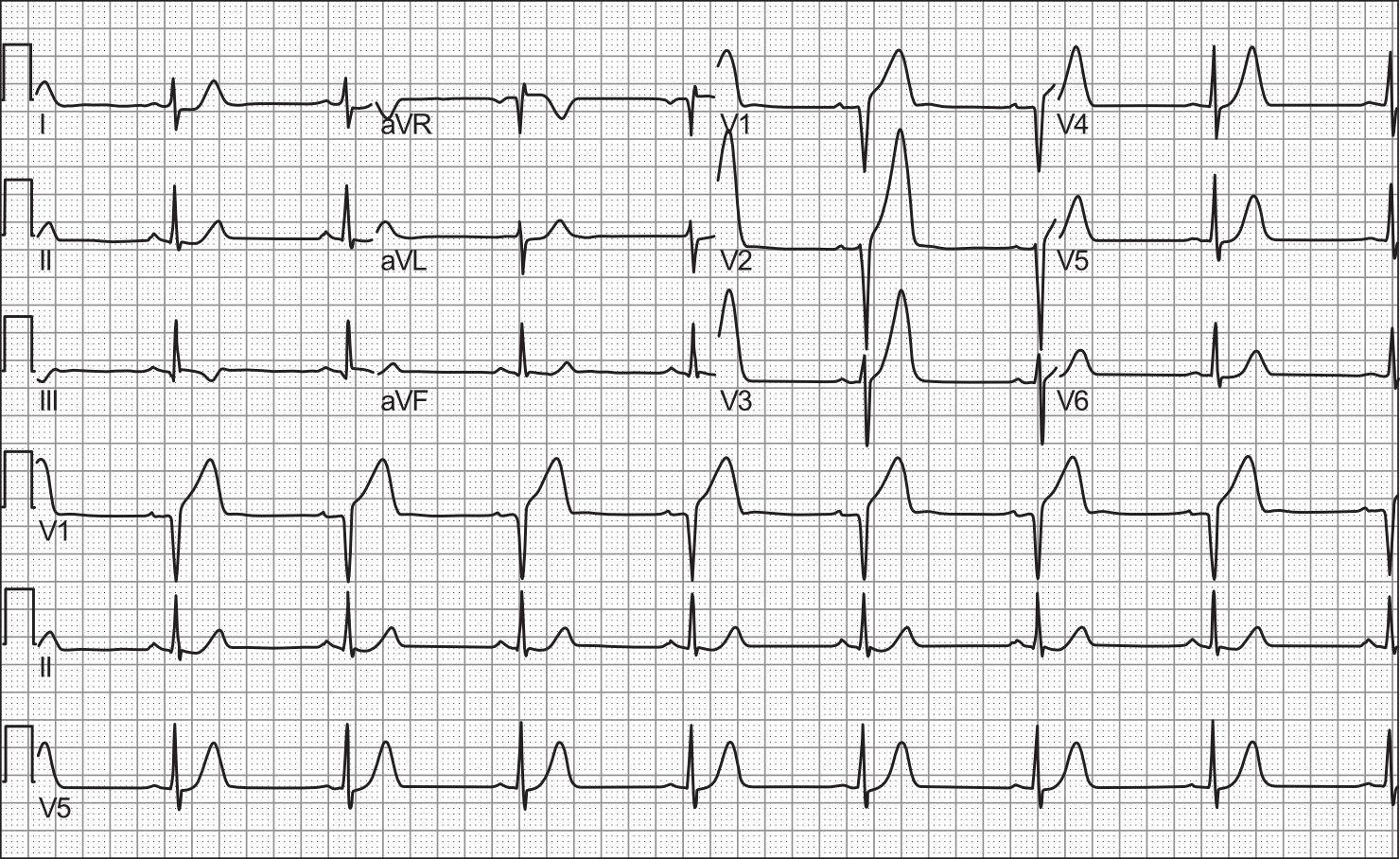 Imagem de referência de enfarte do miocárdio, descrito nos dados abertos como interrupção da irrigação sanguínea para uma parte do coração