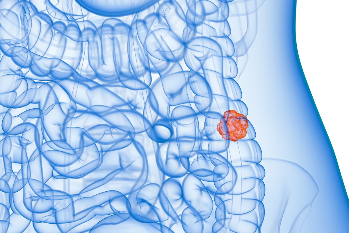 Dieta ruim está ligada a câncer de intestino que causou morte de Lua Blanco