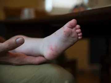 Doença mão-pé-boca é contagiosa? Veja sintomas e como tratar